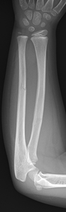 Figure 2_1189342_Greenstick fracture_AP.jpg